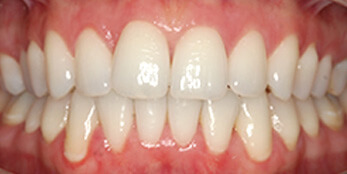 After treatment