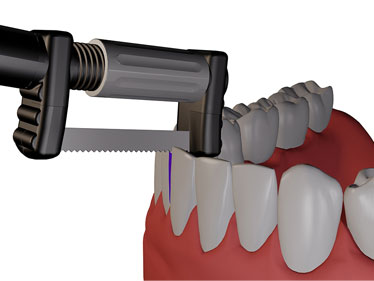 Interproximal Recontouring