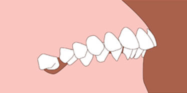 Upper Front Teeth Protrusion